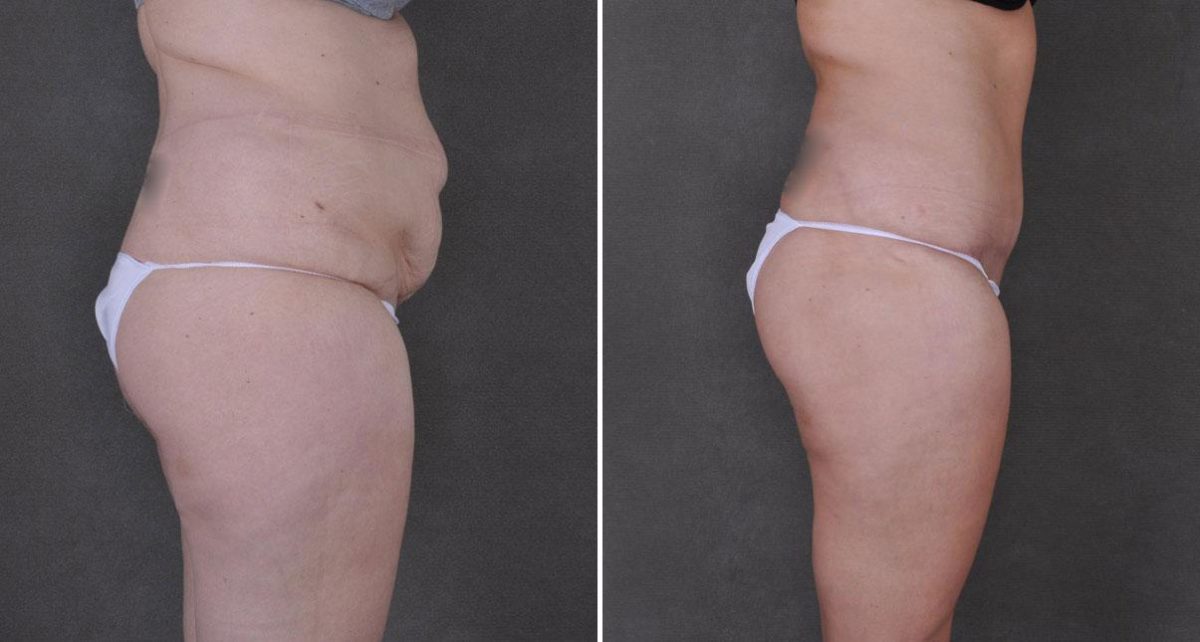 Liposuction Before and After Photos in Omaha, NE, Case 9172