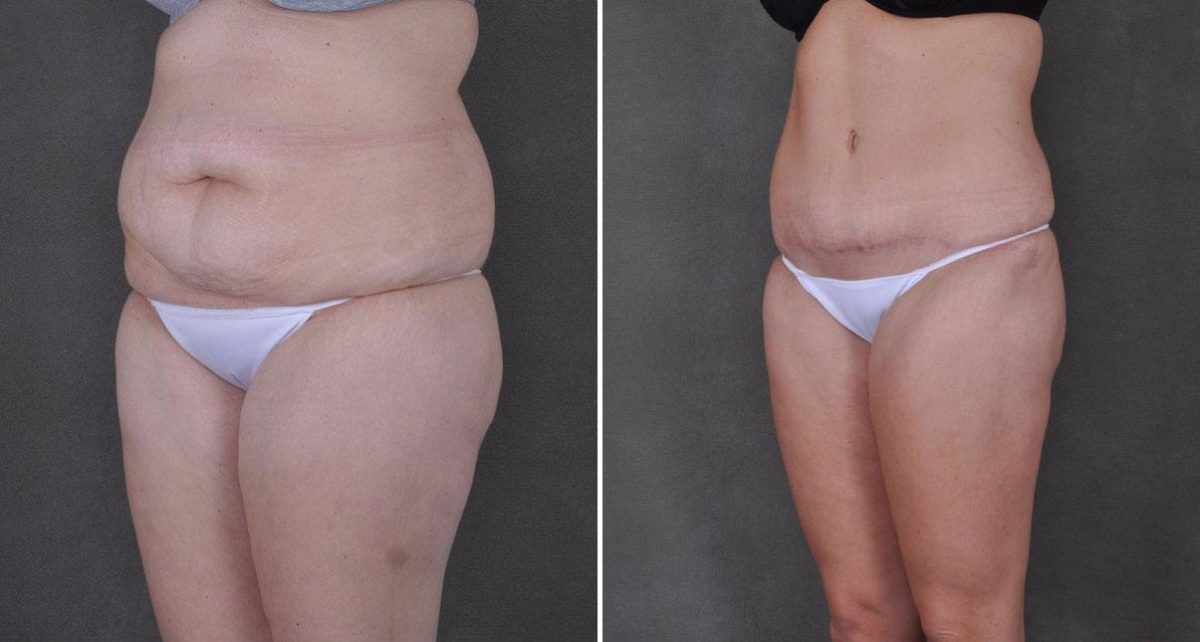 Liposuction Before and After Photos in Omaha, NE, Case 9172