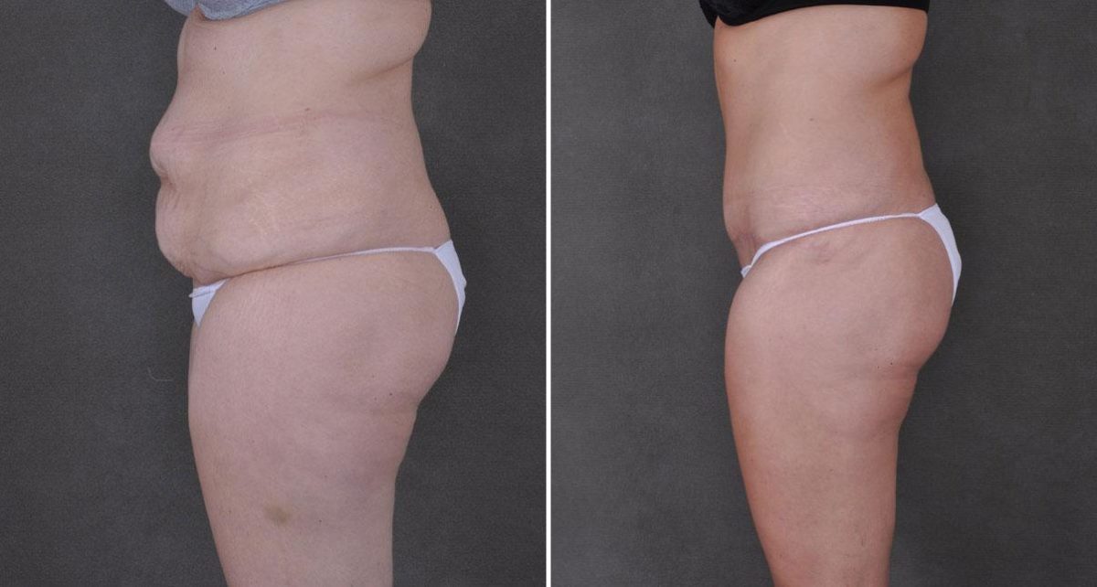 Liposuction Before and After Photos in Omaha, NE, Case 9172