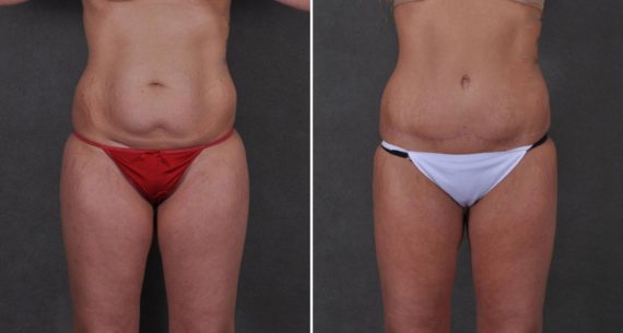 Liposuction Before and After Photos in Omaha, NE, Case 8700