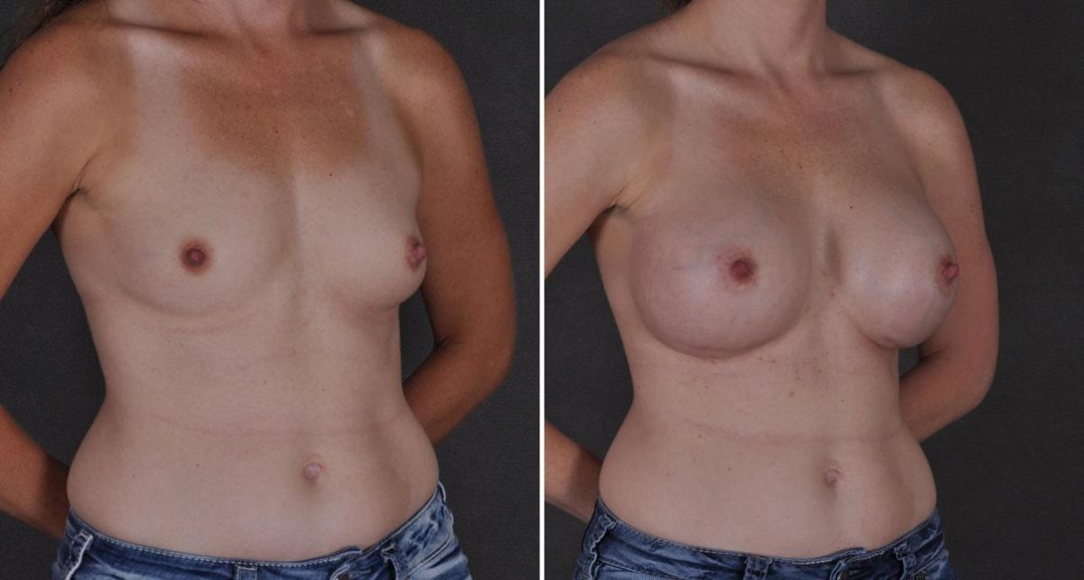 Breast Augmentation Before and After Photos in Omaha, NE, Case 8795