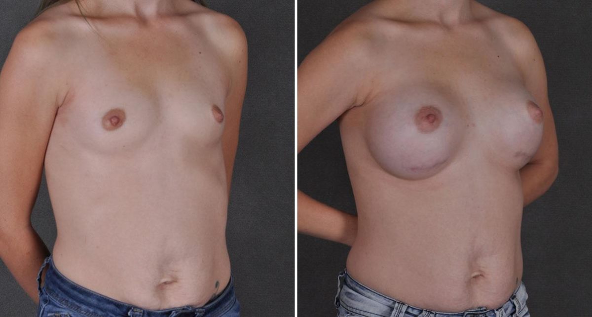 Breast Augmentation Before and After Photos in Omaha, NE, Case 8868