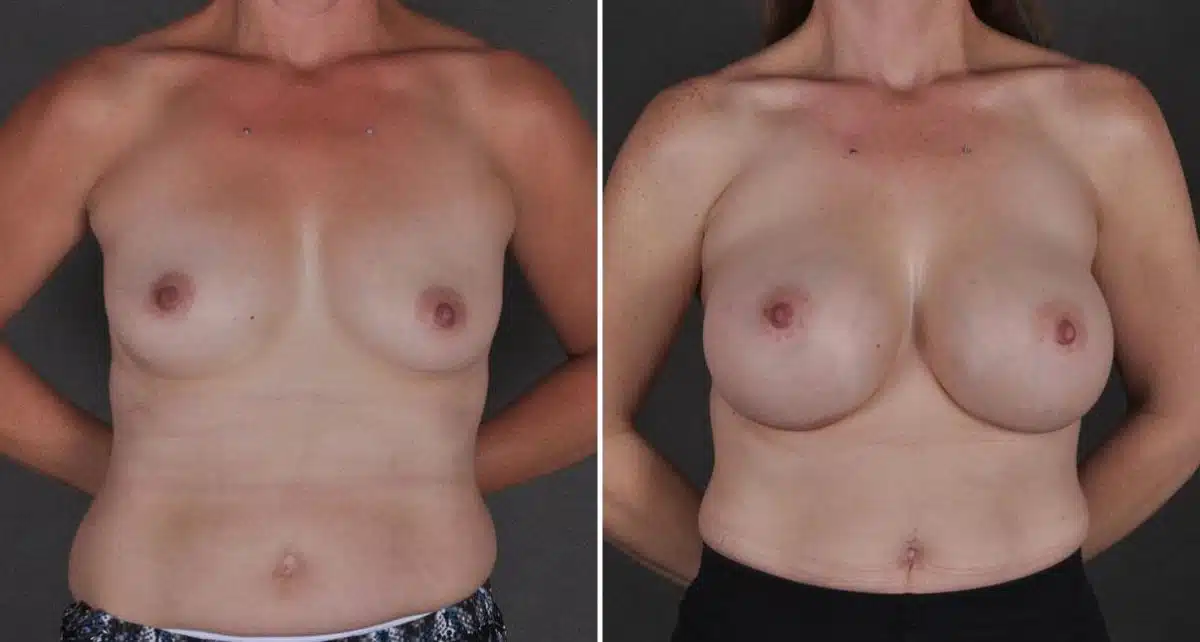 Breast Augmentation Before and After Photos in Omaha, NE, Case 8875