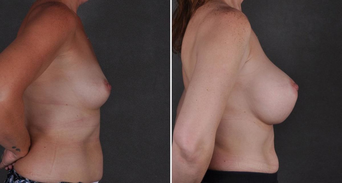 Breast Augmentation Before and After Photos in Omaha, NE, Case 8875