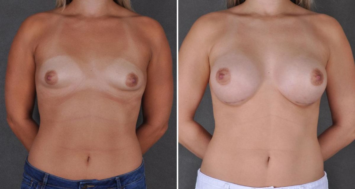 Breast Augmentation Before and After Photos in Omaha, NE, Case 8920