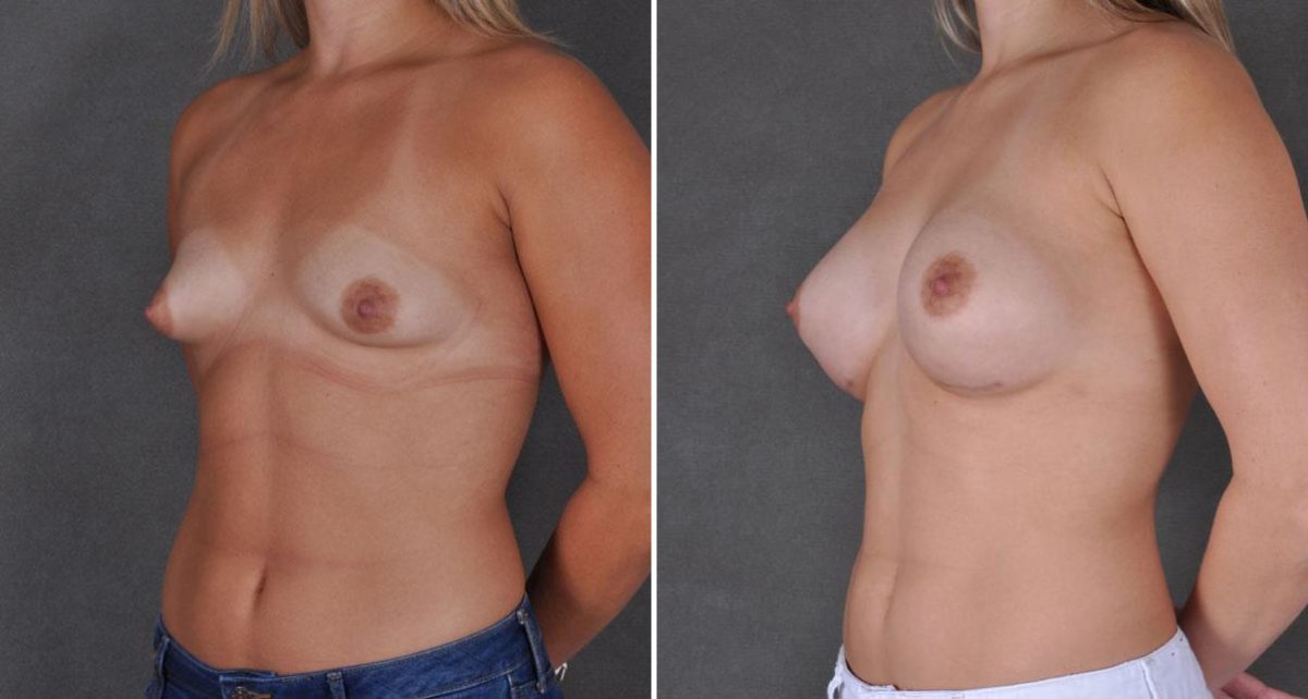 Breast Augmentation Before and After Photos in Omaha, NE, Case 8920