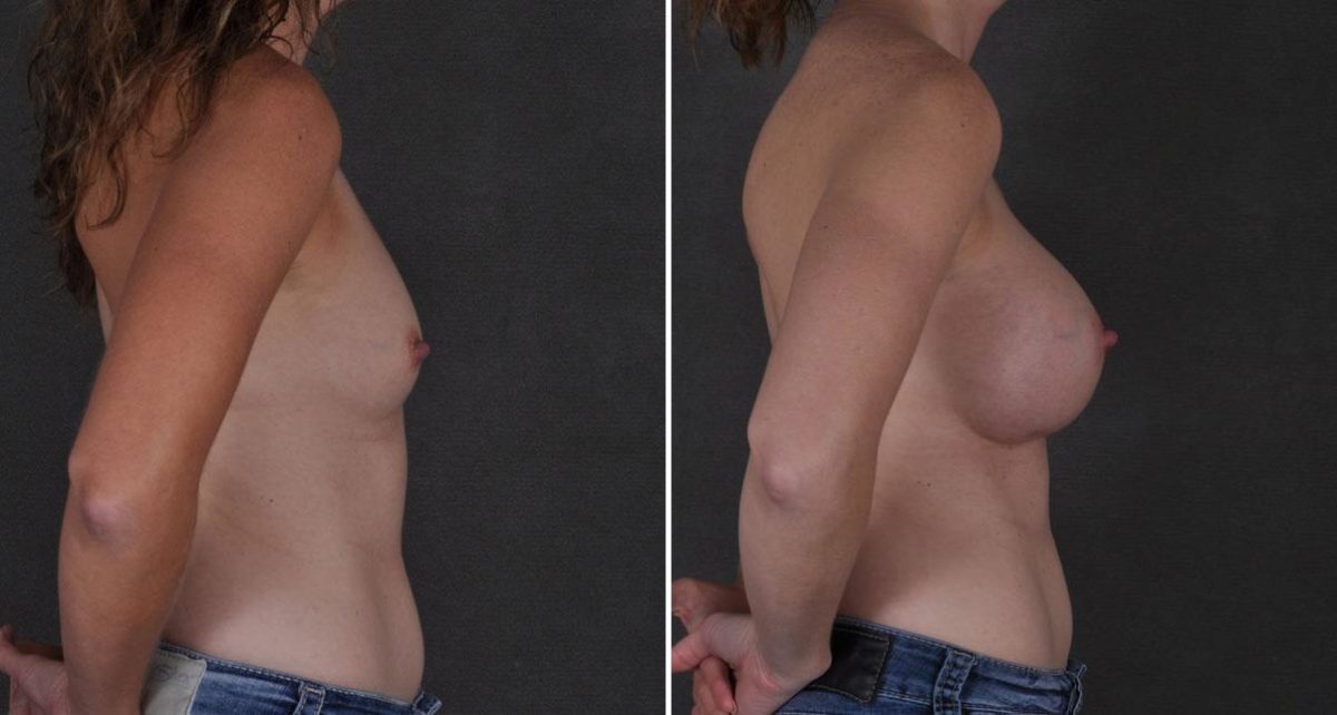 Breast Augmentation Before and After Photos in Omaha, NE, Case 8795