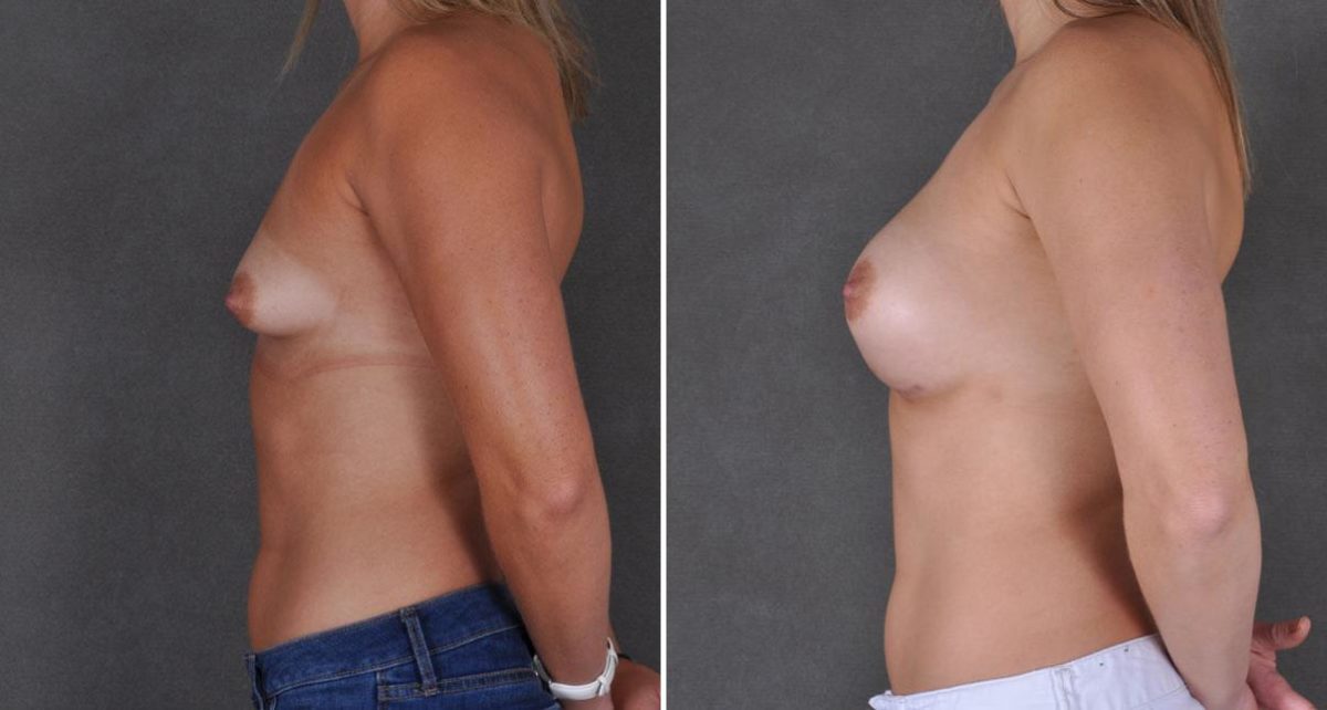 Breast Augmentation Before and After Photos in Omaha, NE, Case 8920