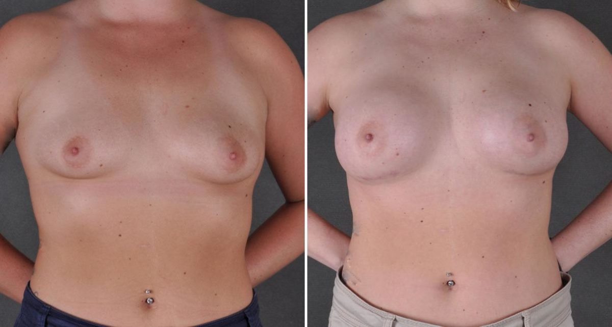 Breast Augmentation Before and After Photos in Omaha, NE, Case 8934