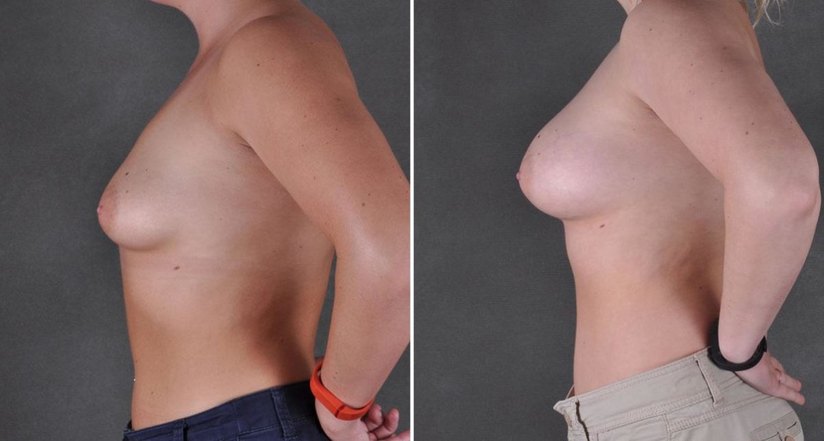 Breast Augmentation Before and After Photos in Omaha, NE, Case 8934