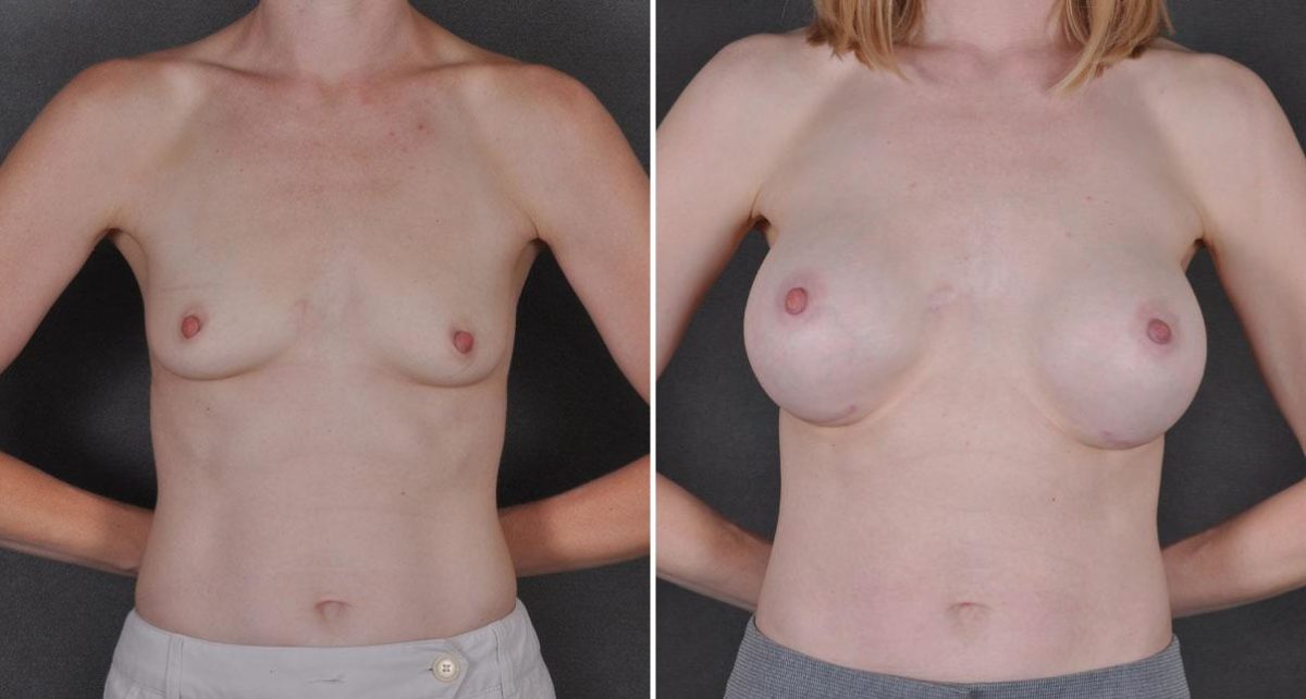 Breast Augmentation Before and After Photos in Omaha, NE, Case 8951