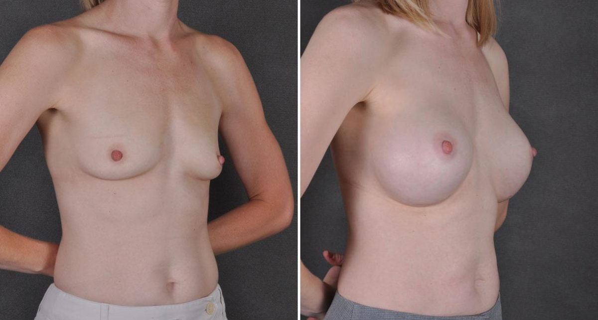 Breast Augmentation Before and After Photos in Omaha, NE, Case 8951