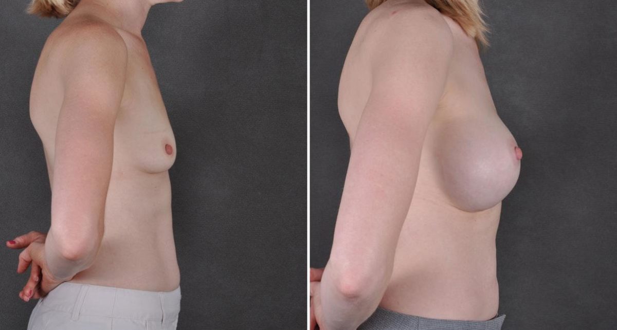 Breast Augmentation Before and After Photos in Omaha, NE, Case 8951