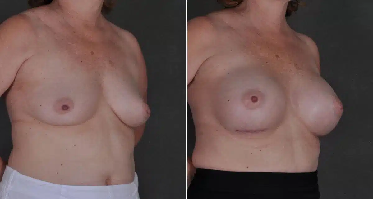 Breast Augmentation Before and After Photos in Omaha, NE, Case 8814