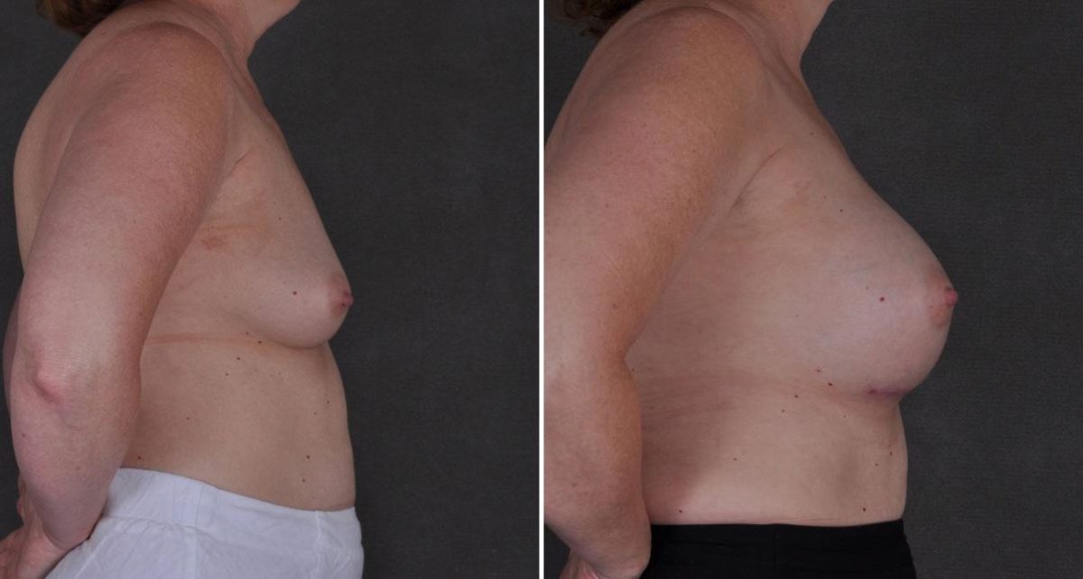 Breast Augmentation Before and After Photos in Omaha, NE, Case 8814