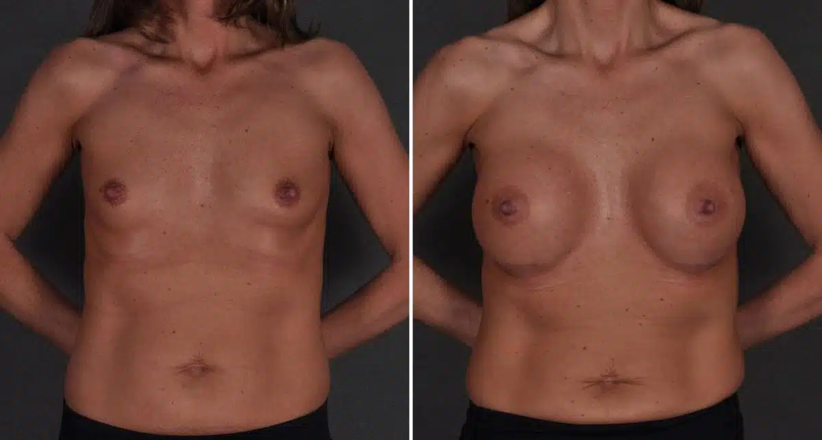 Breast Augmentation Before and After Photos in Omaha, NE, Case 8813