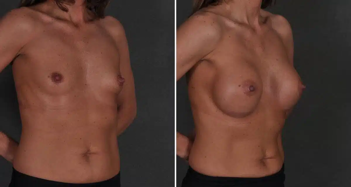 Breast Augmentation Before and After Photos in Omaha, NE, Case 8813