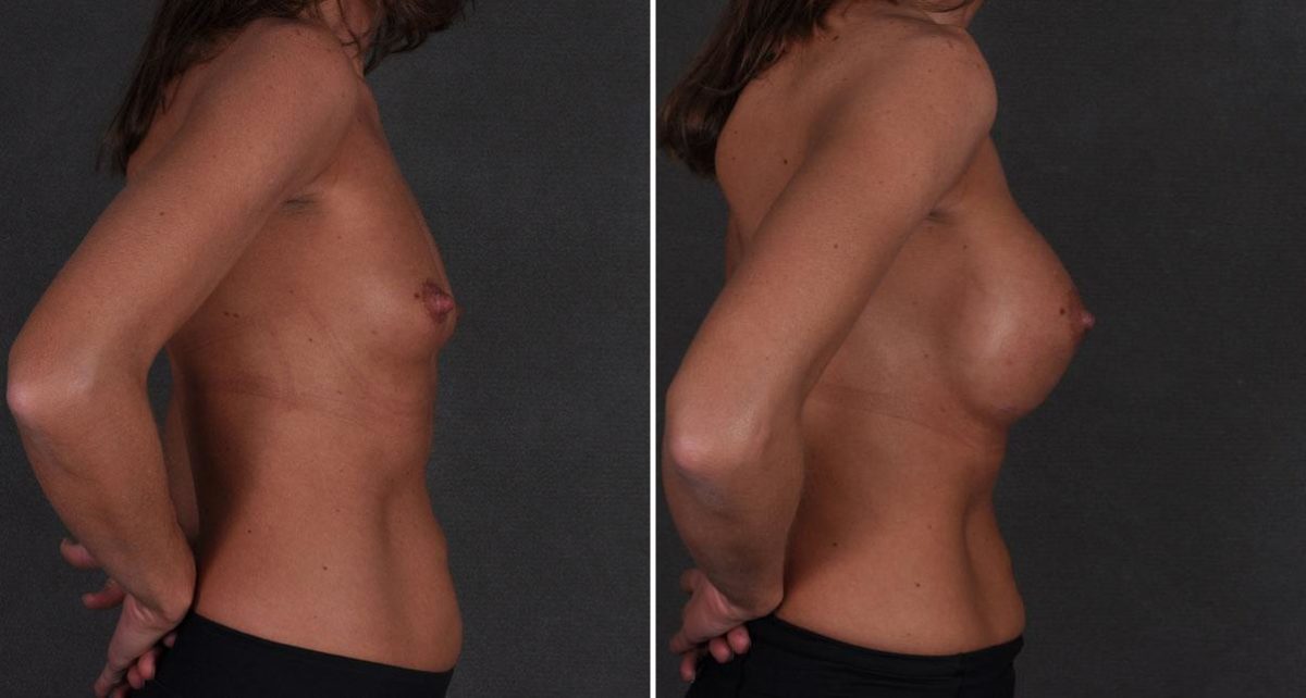 Breast Augmentation Before and After Photos in Omaha, NE, Case 8813