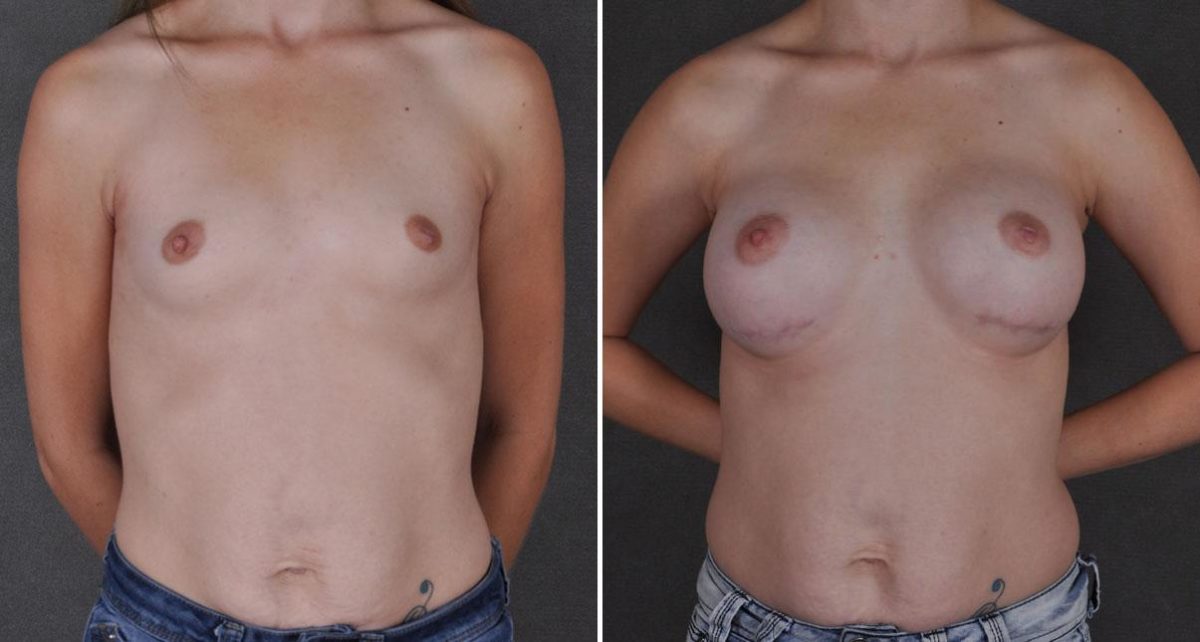 Breast Augmentation Before and After Photos in Omaha, NE, Case 8868