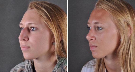 Rhinoplasty Before and After Photos in Omaha, NE, Case 8843