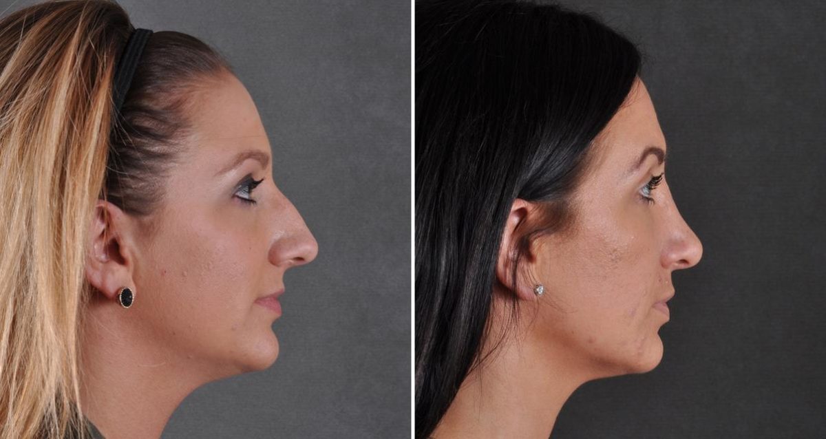 Rhinoplasty Before and After Photos in Omaha, NE, Case 9488