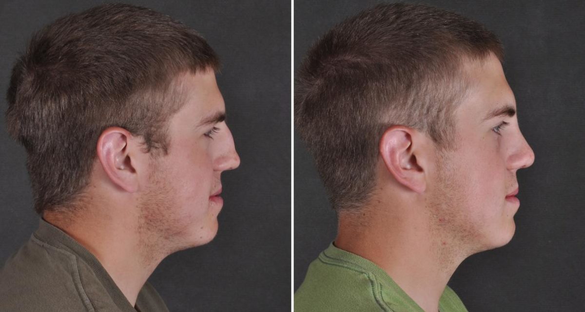 Rhinoplasty Before and After Photos in Omaha, NE, Case 9538