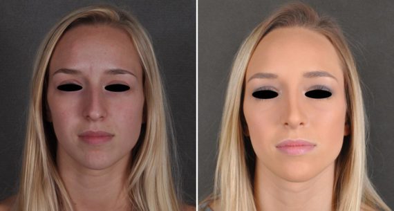 Rhinoplasty Before and After Photos in Omaha, NE, Case 9931