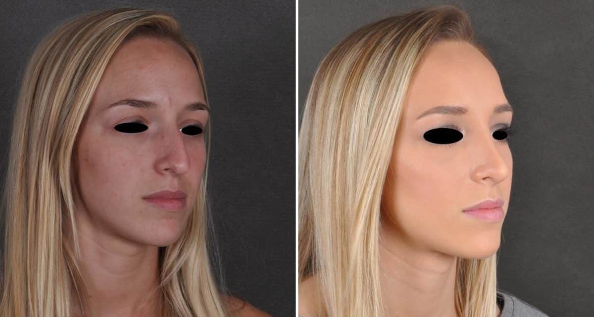 Rhinoplasty Before and After Photos in Omaha, NE, Case 9931