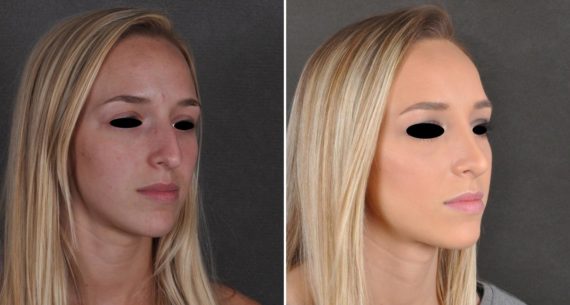 Rhinoplasty Before and After Photos in Omaha, NE, Case 9931