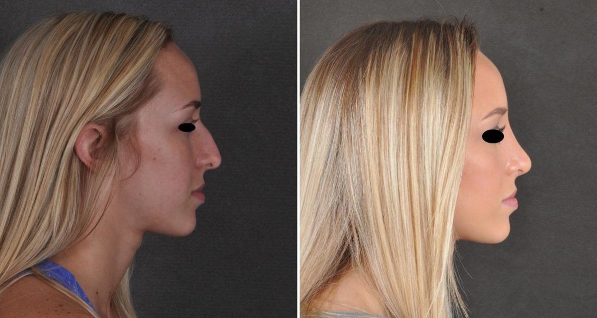 Rhinoplasty Before and After Photos in Omaha, NE, Case 9931