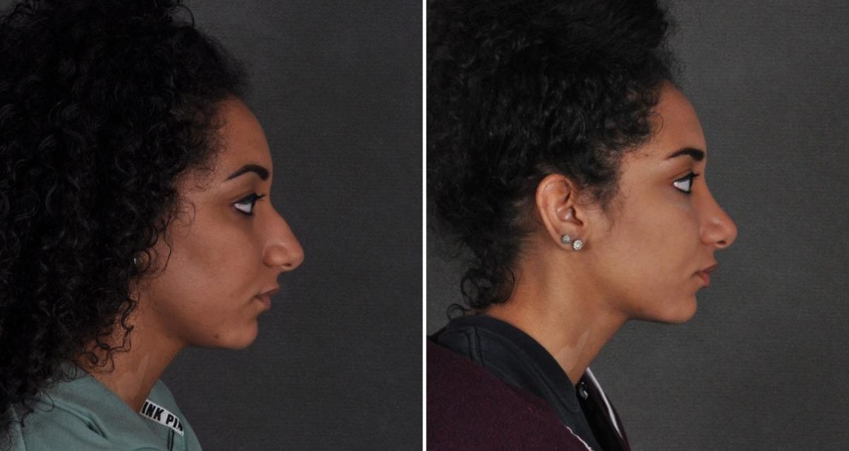 Rhinoplasty Before and After Photos in Omaha, NE, Case 10336