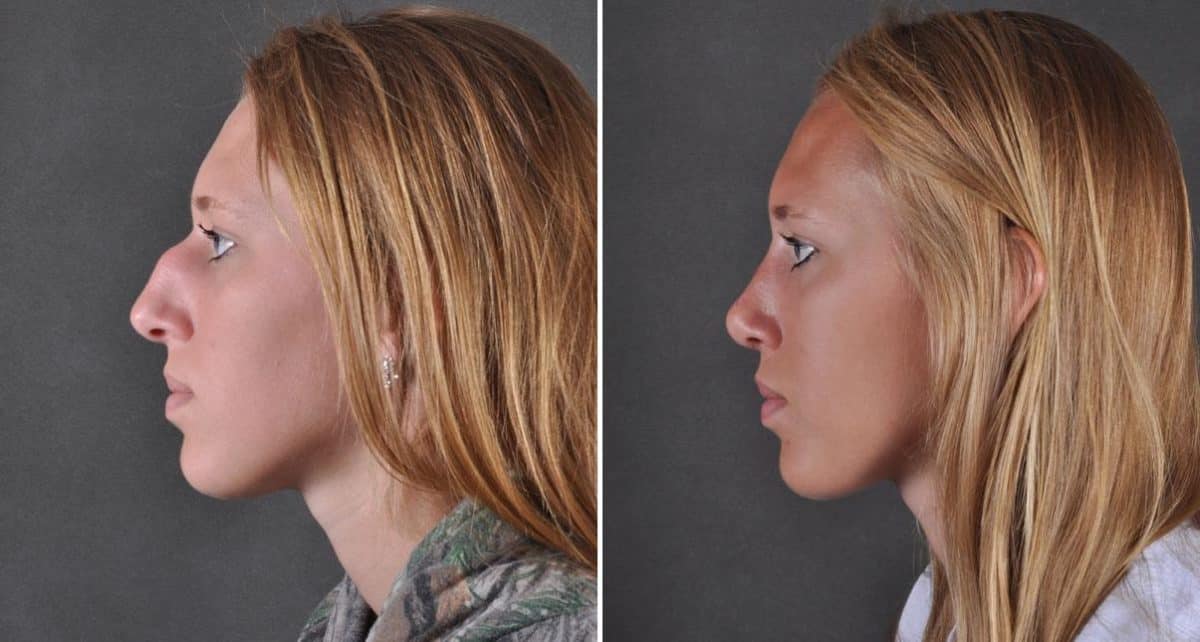 Rhinoplasty Before and After Photos in Omaha, NE, Case 8843