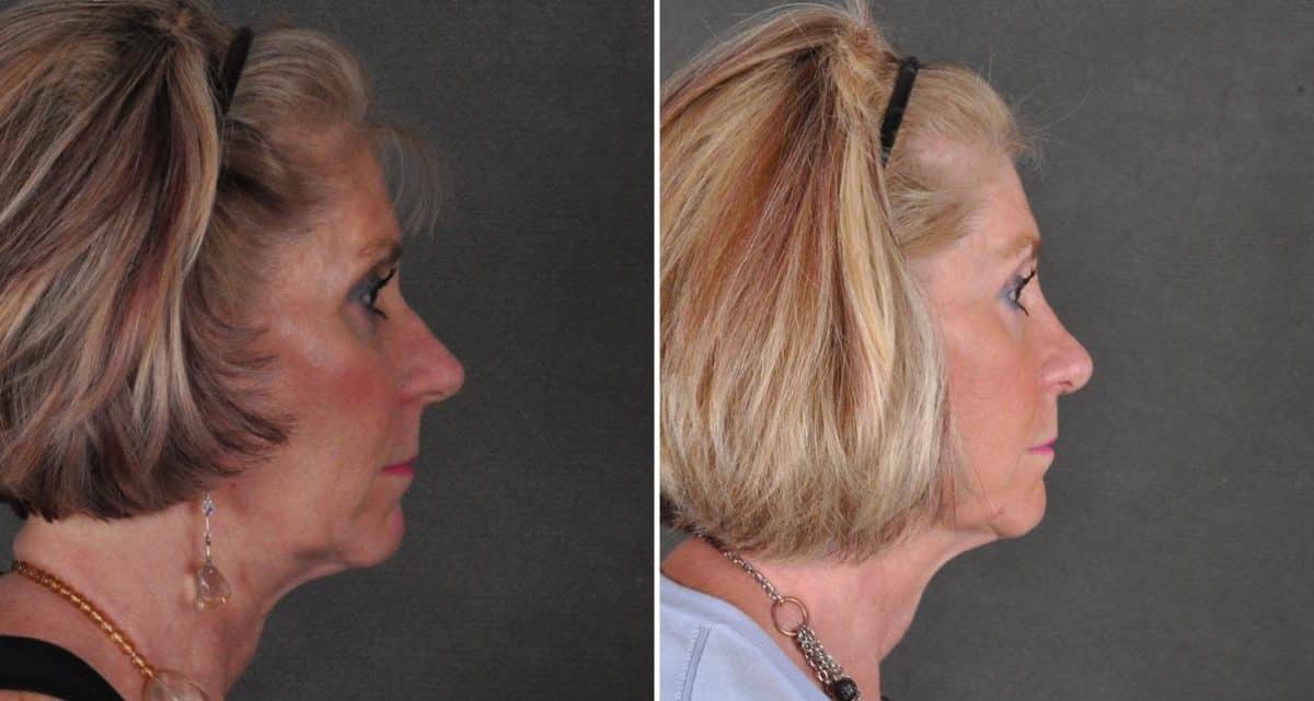 Rhinoplasty Before and After Photos in Omaha, NE, Case 10490