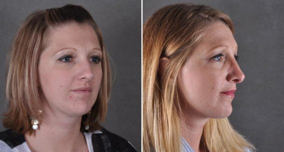 Rhinoplasty Before and After Photos in Omaha, NE, Case 9150