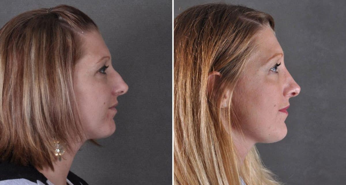 Rhinoplasty Before and After Photos in Omaha, NE, Case 9150