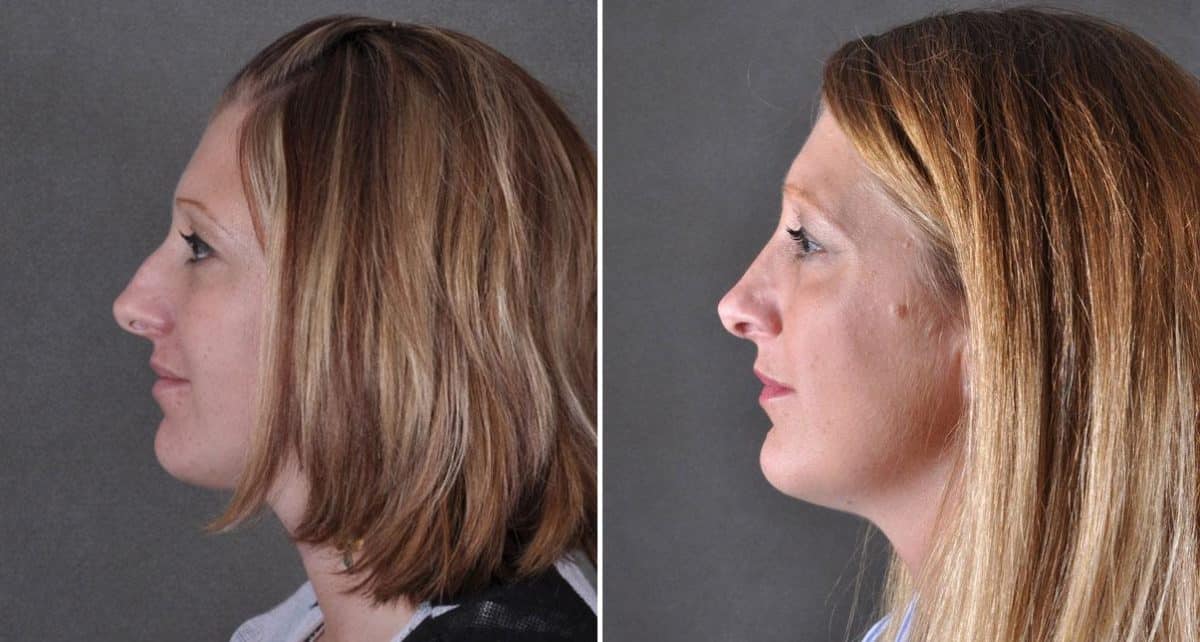 Rhinoplasty Before and After Photos in Omaha, NE, Case 9150