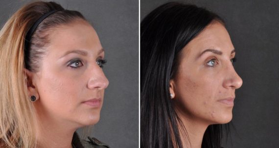 Rhinoplasty Before and After Photos in Omaha, NE, Case 9488