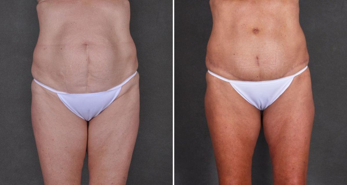 Tummy Tuck Before and After Photos in Omaha, NE, Case 8968