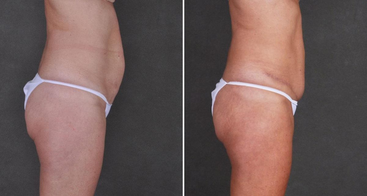 Tummy Tuck Before and After Photos in Omaha, NE, Case 8968