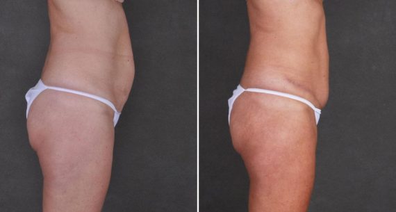 Tummy Tuck Before and After Photos in Omaha, NE, Case 8968