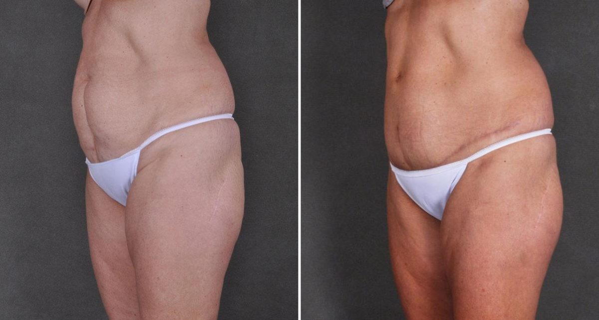 Tummy Tuck Before and After Photos in Omaha, NE, Case 8968