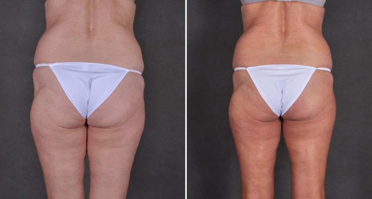 Tummy Tuck Before and After Photos in Omaha, NE, Case 8968