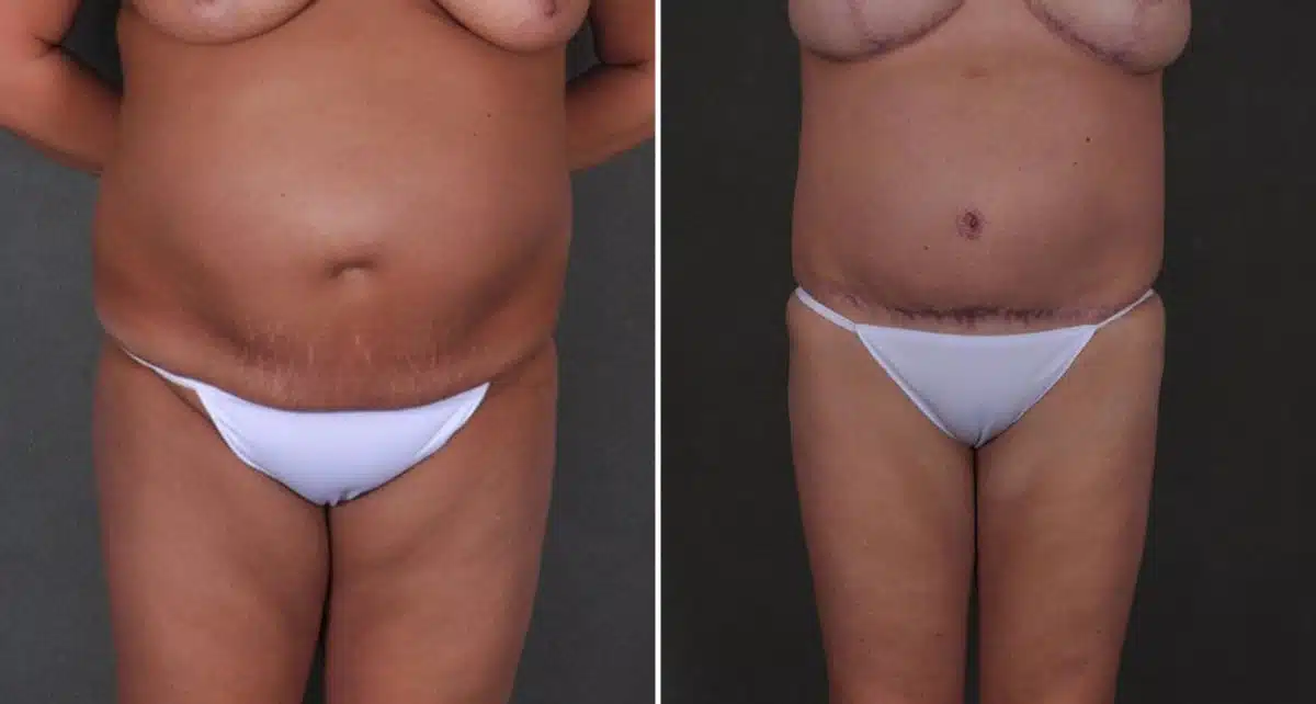 Tummy Tuck Before and After Photos in Omaha, NE, Case 8977