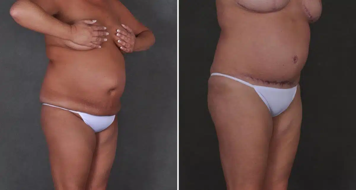 Tummy Tuck Before and After Photos in Omaha, NE, Case 8977