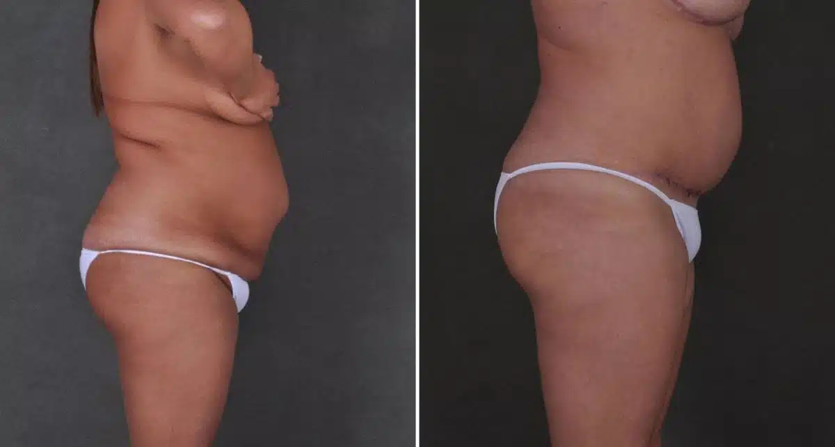 Tummy Tuck Before and After Photos in Omaha, NE, Case 8977