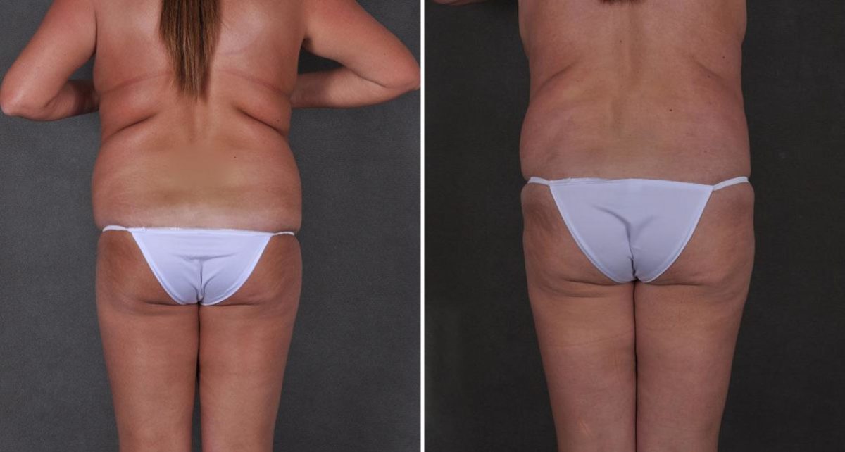 Tummy Tuck Before and After Photos in Omaha, NE, Case 8977