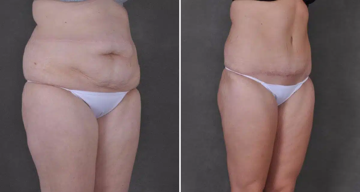 Tummy Tuck Before and After Photos in Omaha, NE, Case 9171