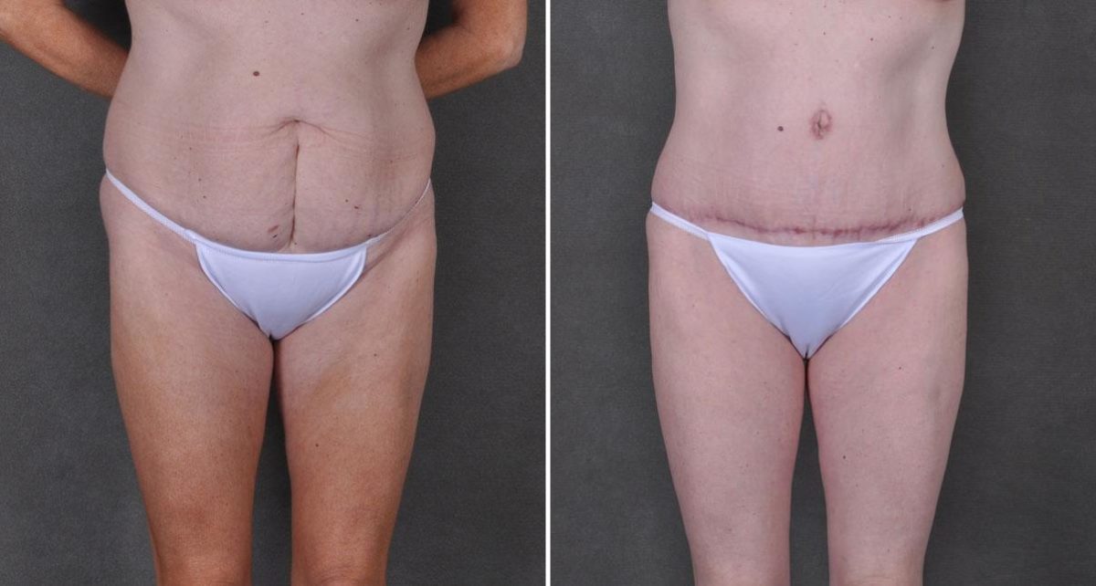 Tummy Tuck Before and After Photos in Omaha, NE, Case 9191