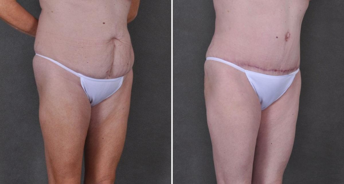 Case 9191, Tummy Tuck Before and After Photos Tummy Tuck Before and After Photos in Omaha, NE, Case 9191