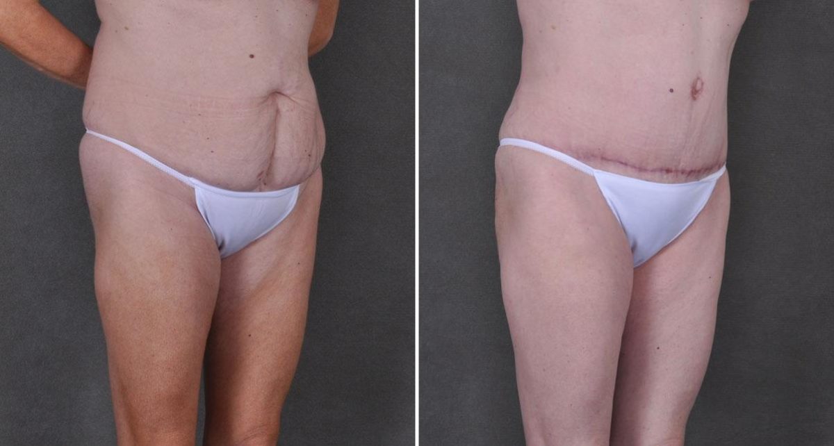 Tummy Tuck Before and After Photos in Omaha, NE, Case 9191